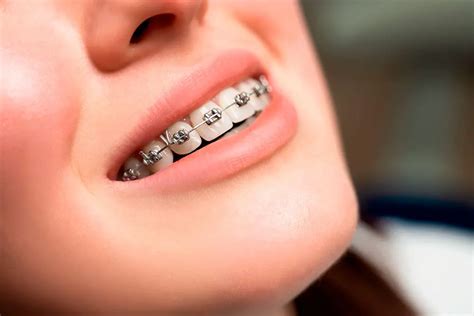 precio de brackets metalicos en argentina|precio de brackets en mexico.